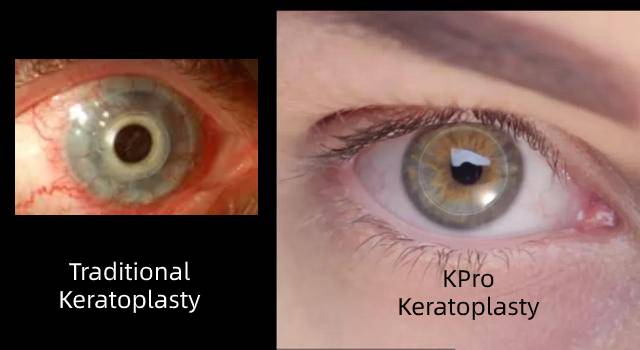 Figure 5（compare appearance between KPro keratoplasty and traditional keratoplasty）